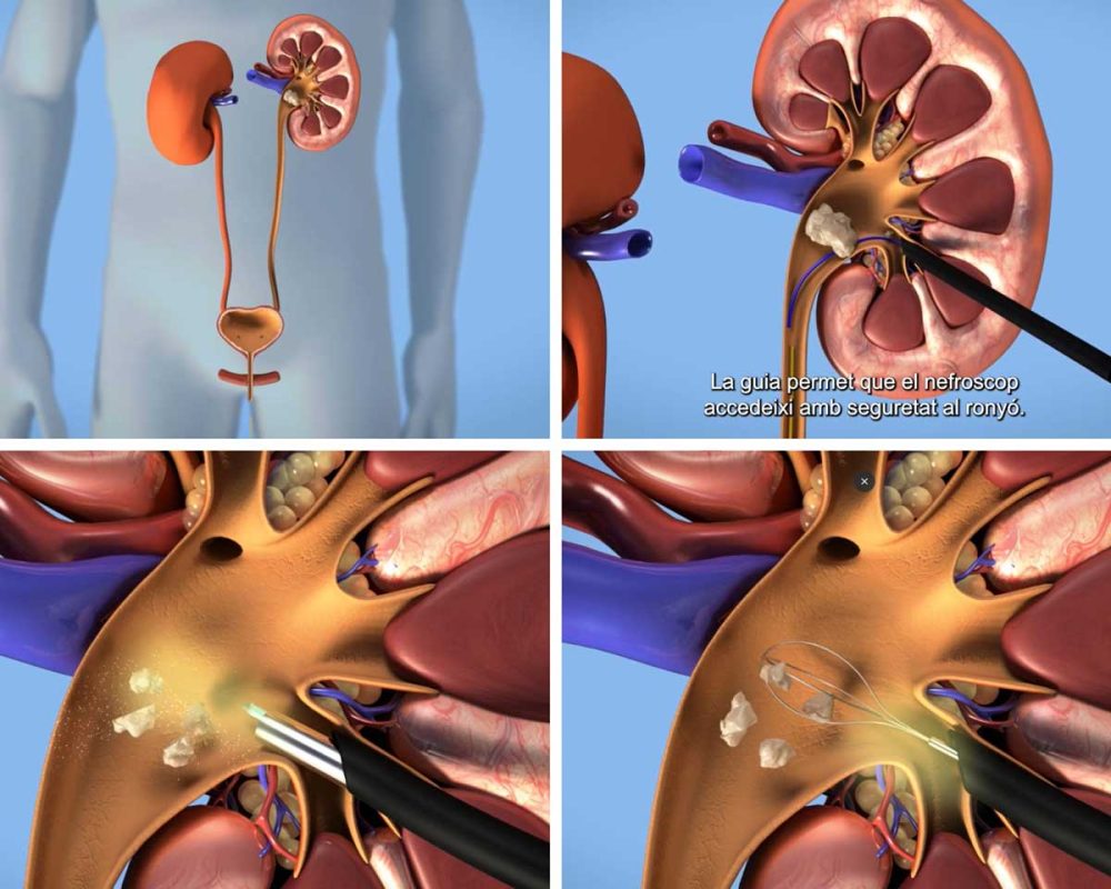 Girona Clinic performs the first Percutaneous Nephrolithotomy to treat kidney stones