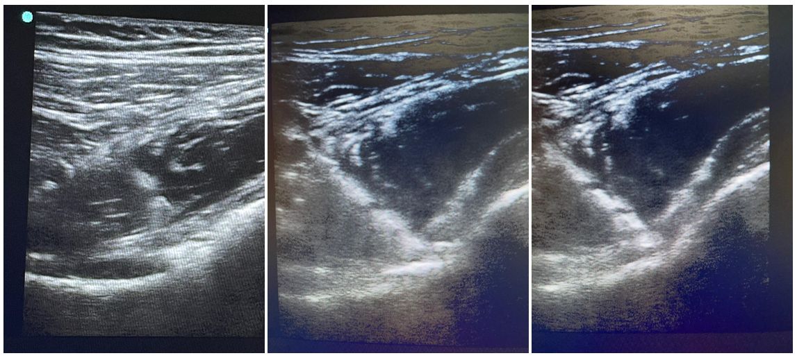 Imatges de l’administració eco-guiada de monòcits